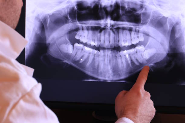 Best Emergency Wisdom Teeth Removal in De Kal, TX