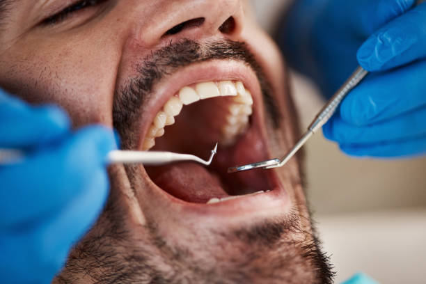 Best Emergency Tooth Extraction in De Kal, TX