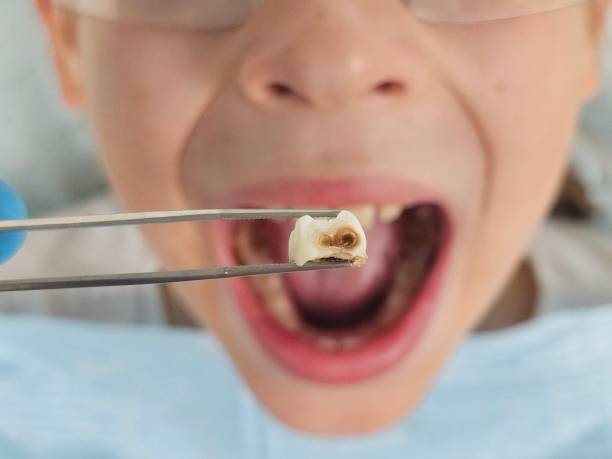 Best Emergency Tooth Extraction in De Kal, TX